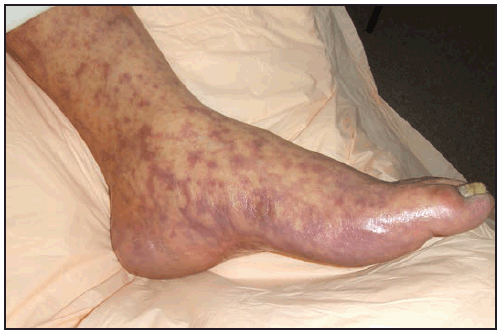 rr6502a1f22.gif This figure is a photograph showing a late-stage petechial purpuric rash involving the sole of the foot in a patient with Rocky Mountain spotted fever.