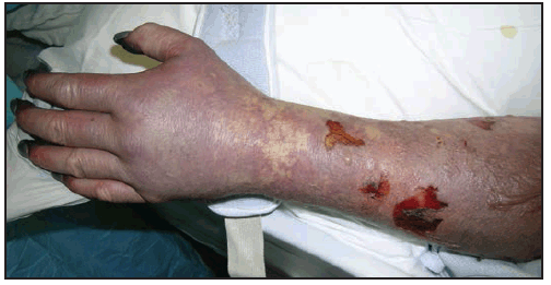 rr6502a1f23.gif This figure is a photograph showing gangrene of the digits in a patient with late-stage Rocky Mountain spotted fever.