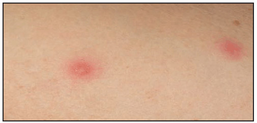 rr6502a1f25.gif This figure is a photograph showing a vesiculopapular rash associated with Rickettsia parkeri rickettsiosis.