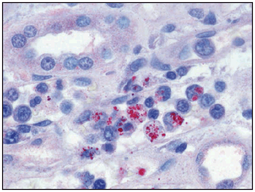 rr6502a1f27.gif This figure is a photograph showing an immunohistochemical stain demonstrating Ehrlichia chaffeensis morulae (red) within monocytes in the kidney of a patient with ehrlichiosis.