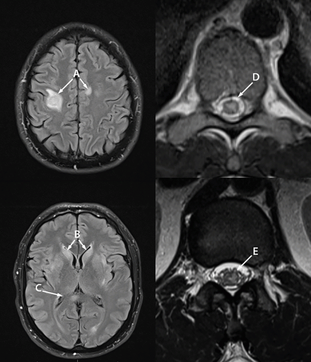 Two Cases of Monkeypox-Associated Encephalomyelitis — Colorado and the District of Columbia, July–August 2022 The figure is a magnetic resonance imaging (MRI) of the brain, thoracic spine, and conus medullaris of a with monkeypox-associated encephalomyelitis.