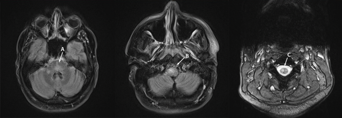 Two Cases of Monkeypox-Associated Encephalomyelitis — Colorado and the District of Columbia, July–August 2022 Magnetic resonance imaging (MRI) of the brain and cervical spine of a patient with monkeypox-associated encephalomyelitis.