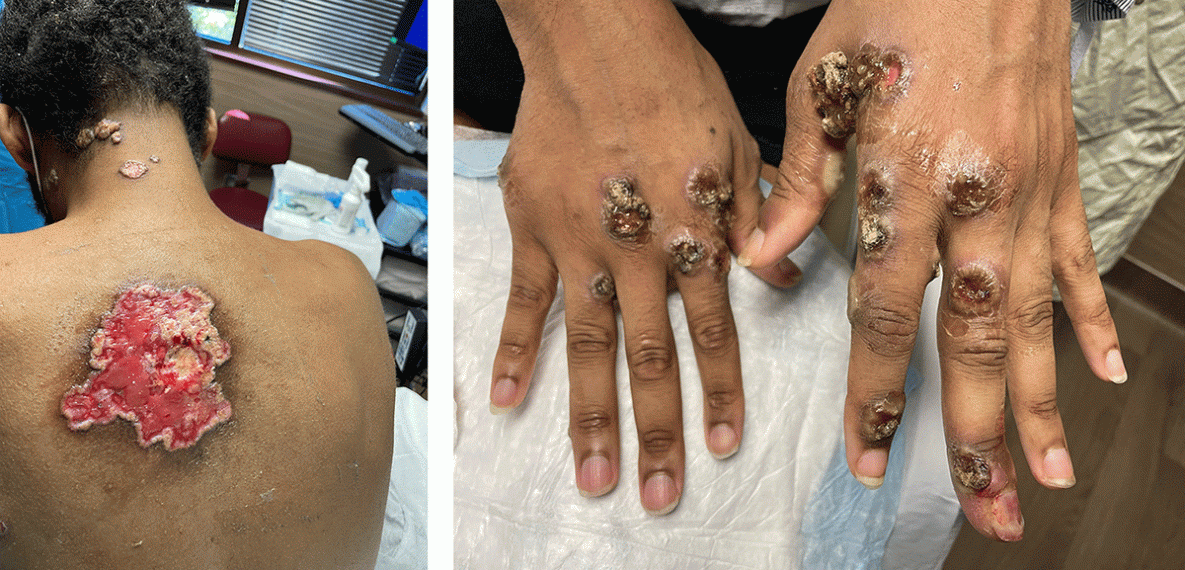 Severe Monkeypox in Hospitalized Patients — United States, August 10–October 10, 2022 This figure is an image of patients with severe monkeypox infection. One patient has a large monkeypox lesion on their back and the other patient has several monkeypox lesions on their hands.