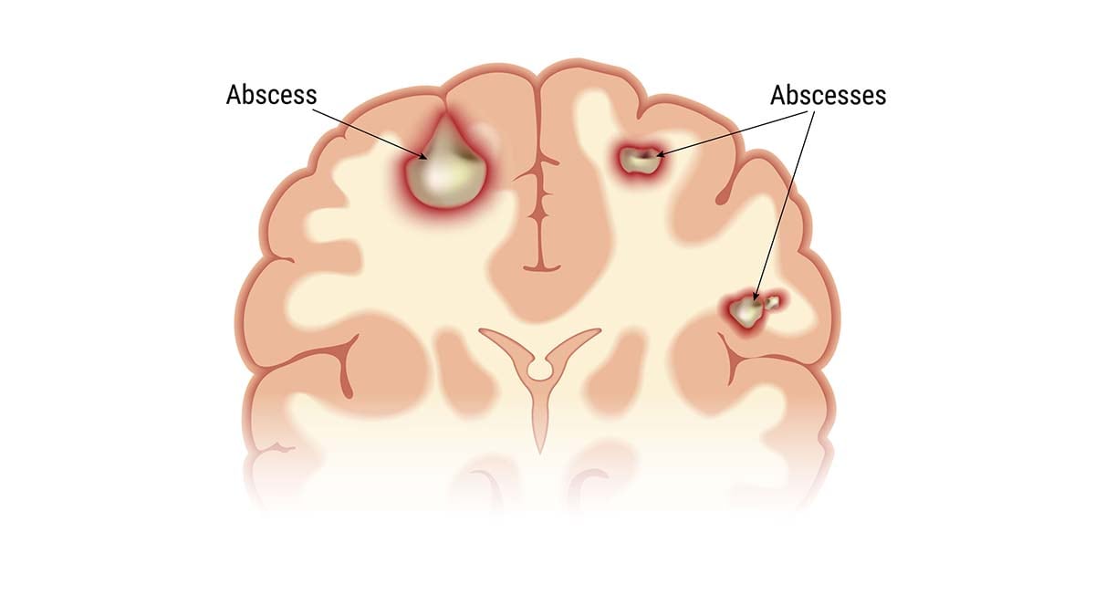 Notes from the Field: Update on Pediatric Intracranial Infections — 19  States and the District of Columbia, January 2016–March 2023 | MMWR