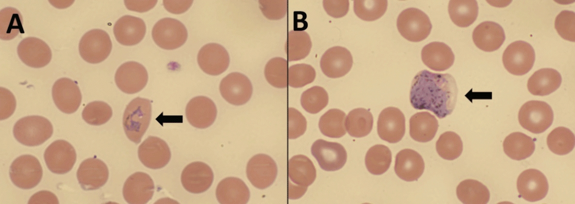 Locally Acquired (Autochthonous) Mosquito-Transmitted Plasmodium vivax Malaria — Saline County, Arkansas, September 2023 The figure comprises two photographs of a thin blood smear from the patient in Arkansas in September 2023, demonstrating Plasmodium vivax/ovale ring-form trophozoite and gametocyte.