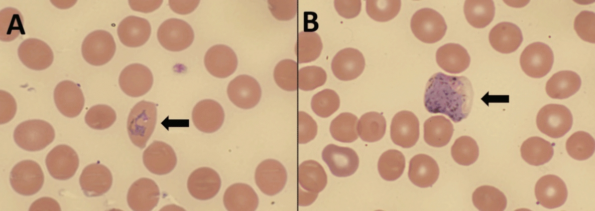 The figure comprises two photographs of a thin blood smear from the patient in Arkansas in September 2023, demonstrating Plasmodium vivax/ovale ring-form trophozoite and gametocyte.