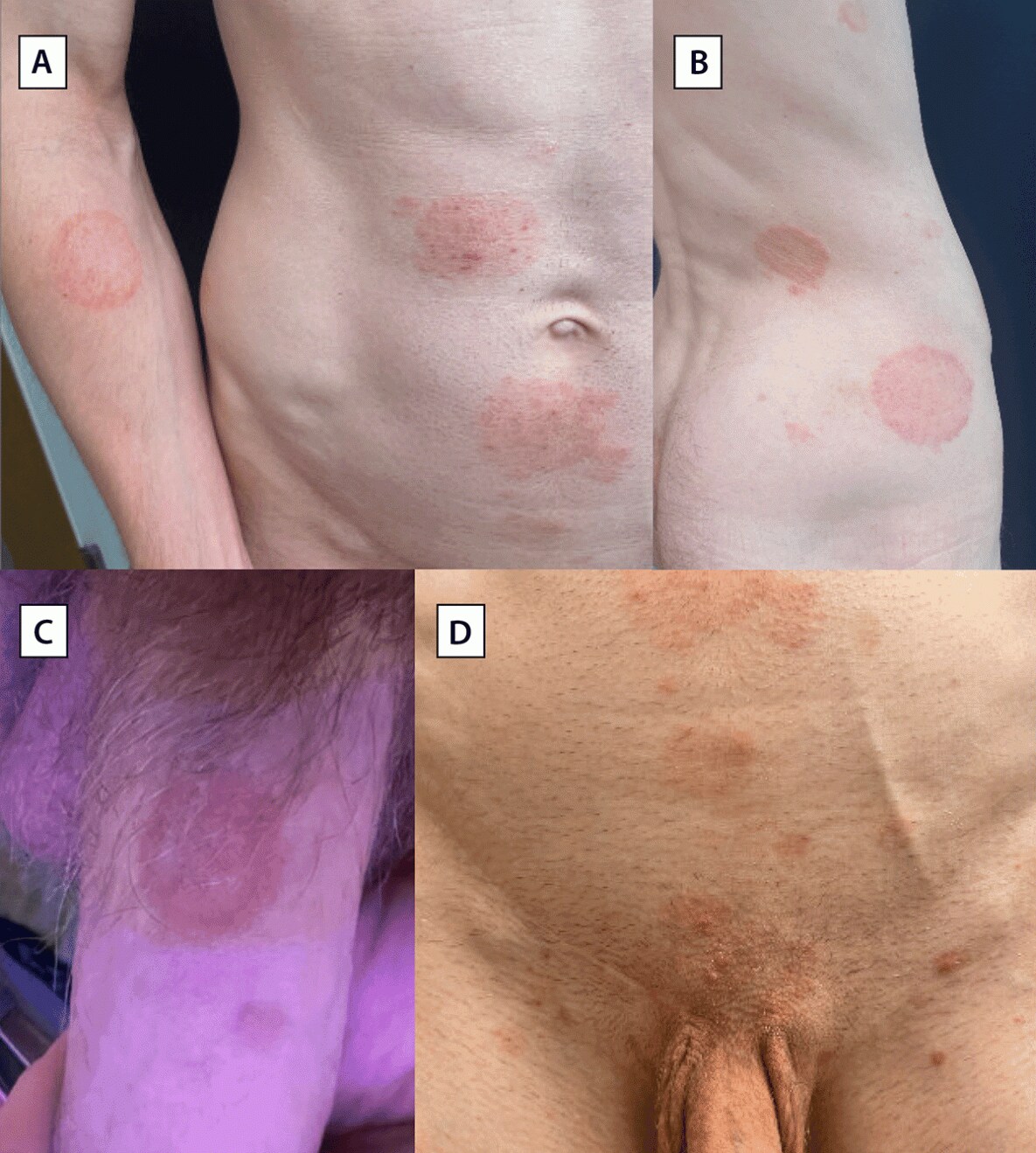 Notes from the Field: Trichophyton mentagrophytes Genotype VII — New York City, April–July 2024 The figure comprises four photos illustrating clinical signs at initial dermatology evaluation for one of four patients with Trichophyton mentagrophytes genotype VII rash, with two photos showing tinea corporis, one showing tinea genitalis, and one showing both tinea corporis and tinea pubogenitalis, in New York City during April–July 2024.