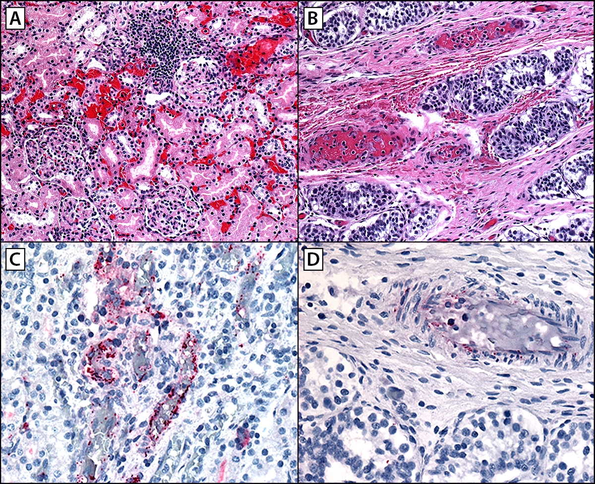 Severe and Fatal Rocky Mountain Spotted Fever After Exposure in Tecate, Mexico — California, July 2023–January 2024 Figure is a series of four images illustrating the histopathologic findings in a fatal pediatric case of Rocky Mountain spotted fever showing extensive microhemorrhages, vascular inflammation, and endothelial injury in multiple organs including kidneys (A), testes (B), and rickettsial antigens identified by immunohistochemistry distributed predominately in endothelial cells of capillaries, arterioles, and venules in the vasa recta in the kidneys (C), and in interstitial areas in testes (D) in California in August 2023.
