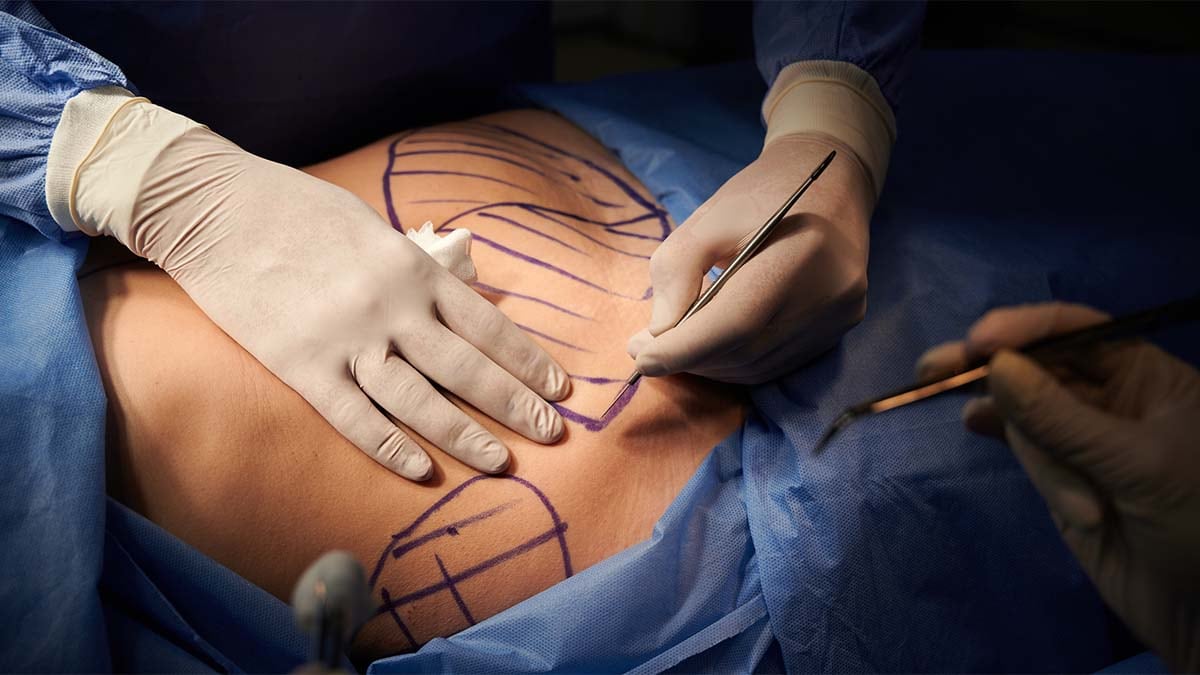 Deaths of U.S. Citizens Undergoing Cosmetic Surgery — Dominican ...