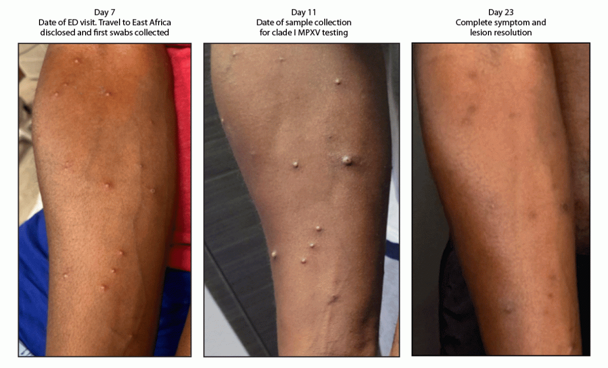 First Clade Ib Monkeypox Virus Infection Reported in the Americas — California, November 2024 The figure is a series of three photographs illustrating progression of lesions in a patient with clade 1b monkeypox virus infection 7, 12, and 23 days after return to the United States from East Africa in California during 2024.