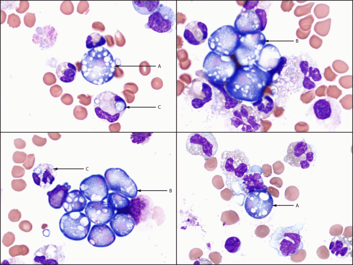 Fatal Case of Splash Pad–Associated Naegleria fowleri Meningoencephalitis — Pulaski County, Arkansas, September 2023 The figure is a set of four Wright-Giemsa stained (x1,000 magnification) cerebrospinal fluid cytospin slide images from a patient with fatal primary amebic meningoencephalitis, demonstrating numerous Naegleria fowleri trophozoites seen as extracellular single forms or clusters, with a predominantly neutrophilic background inflammatory response including neutrophils phagocytizing N. fowleri microorganisms in Pulaski County, Arkansas, in September 2023.