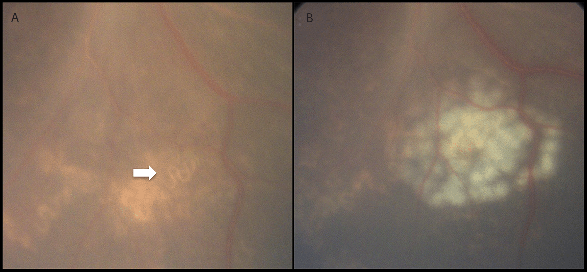 The figure consists of two color images of an eye that illustrate a live subretinal nematode (left) and the treated area of the eye (right) immediately after laser ablation treatment in a patient with diagnosed baylisascariasis .
