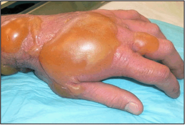 The figure a photo illustrating an example of an injury to skin exposed to sulfur mustard&ndash;containing chemical warfare munitions.
