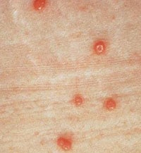 Typical molluscum bumps with pearly appearance and dimples in the centers.