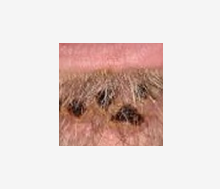 A close up photo of several lesions on a light-skinned person. The lesions are dark and scabbed.