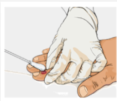 Healthcare provider collects an monkeypox specimen