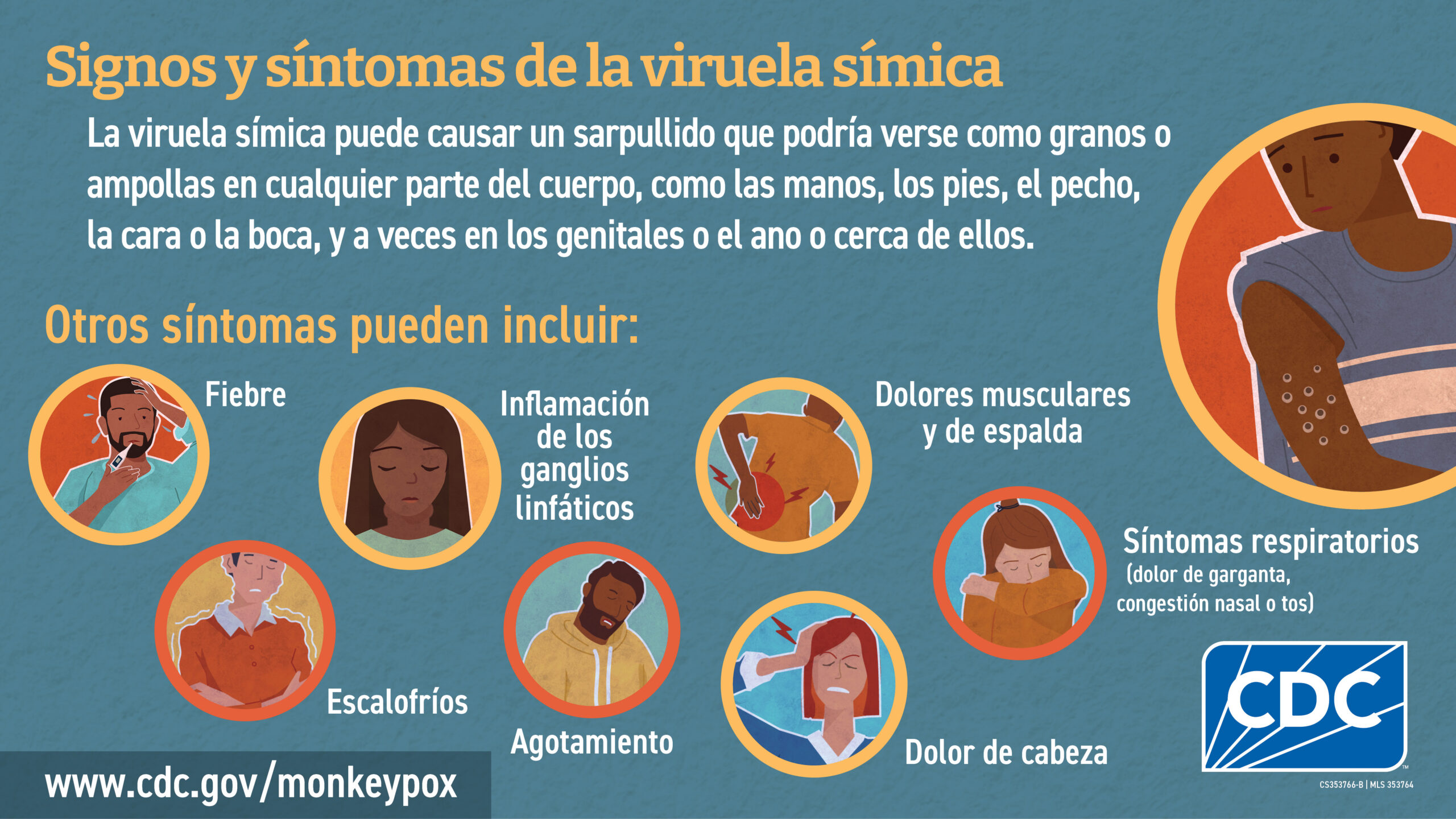 Sintomas incluyen fiebre, escalofrios, inflmacion de los ganglios linfaticos, dolores musculares y de espalda, dolor de cabeza, sintomas respiratorios