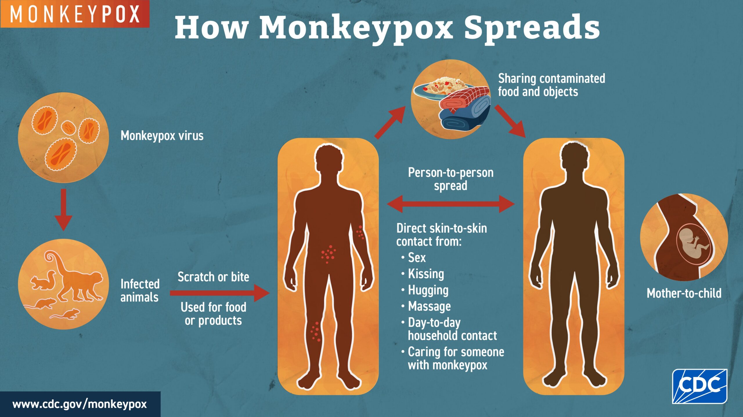 Monkeypox can spread through close contact with a person with monkeypox; contact with contaminated materials used by someone with monkeypox; and direct contact with infected wild animals in areas where monkeypox occurs historically.