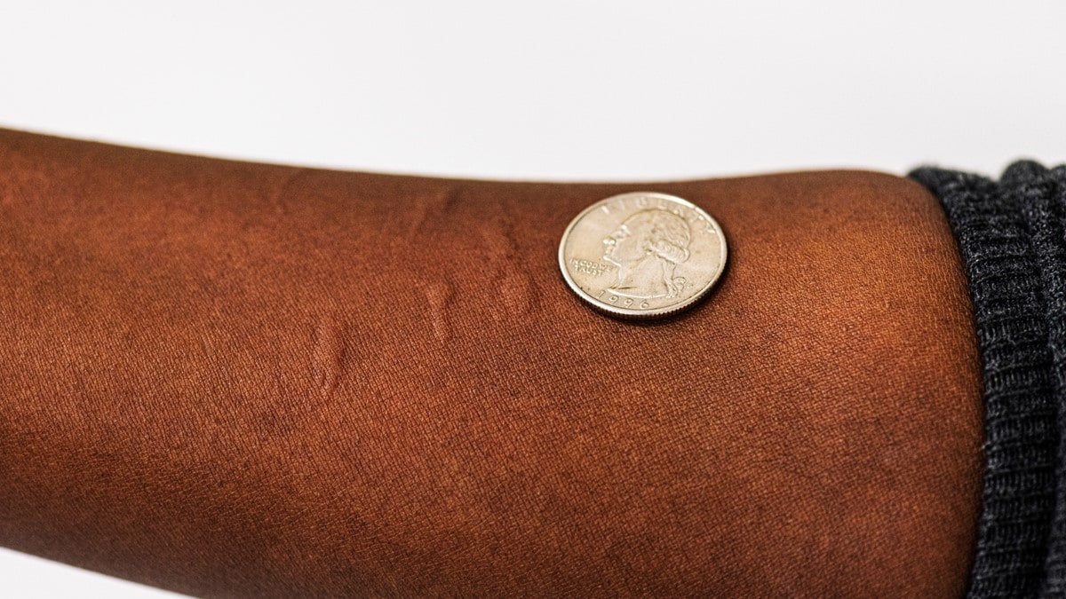 Foto que muestra múltiples picaduras de mosquito en el antebrazo de una persona y una moneda de 25 centavos de dólar para mostrar la escala.