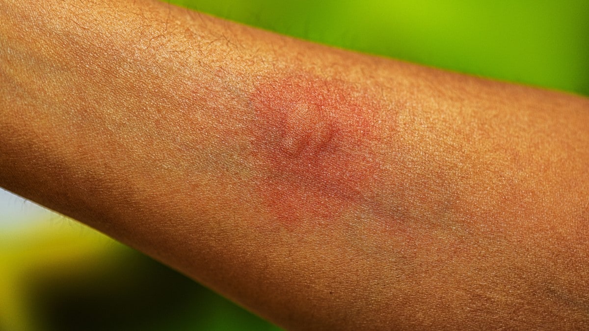 Foto que muestra múltiples picaduras de mosquito en el antebrazo de una persona.