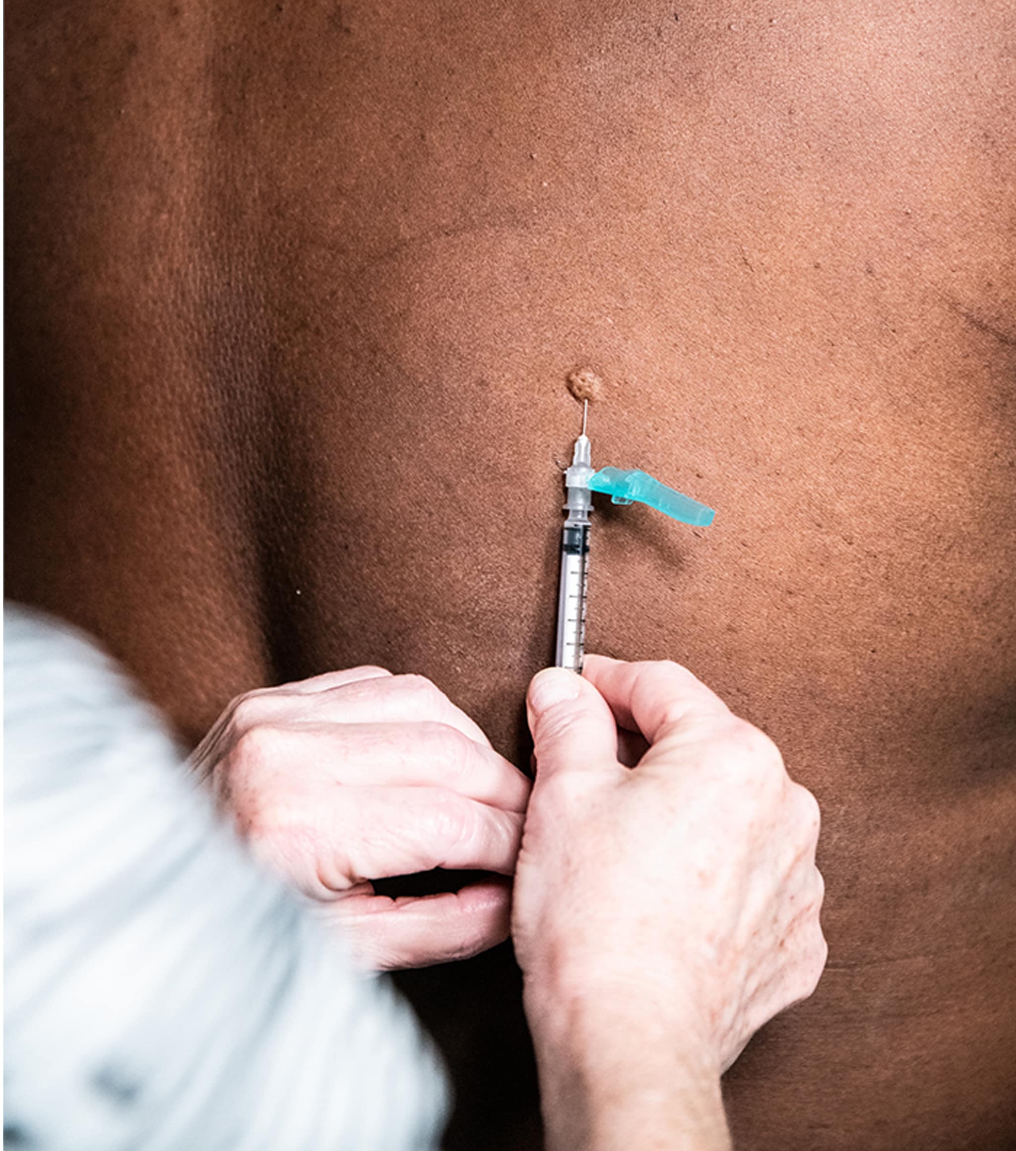 Image of a hand inserting a vaccination into a dark-skinned person's upper back.