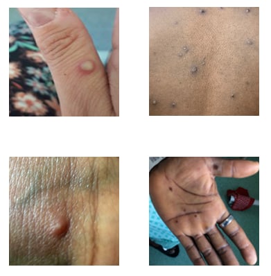 Four photos of mpox rashes on different parts of the body.