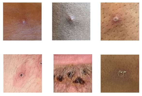 Six photos of mpox lesions on different skin tones and types.