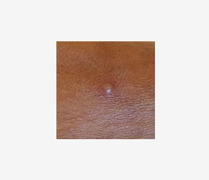 Close up photo of a small bump on a dark-skinned person. The bump is blister-like.