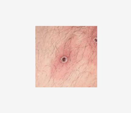 A photo of two lesions on a light-skinned person. The lesions are round and have black centers. The skin around the lesions is reddened.