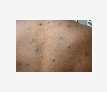 Photo of multiple dark bumps on a dark-skinned person's back