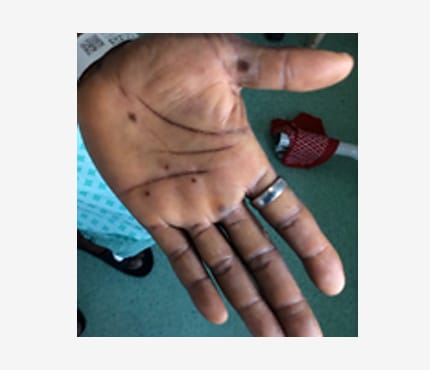 Photo of a dark-skinned person's hand with multiple dark bumps