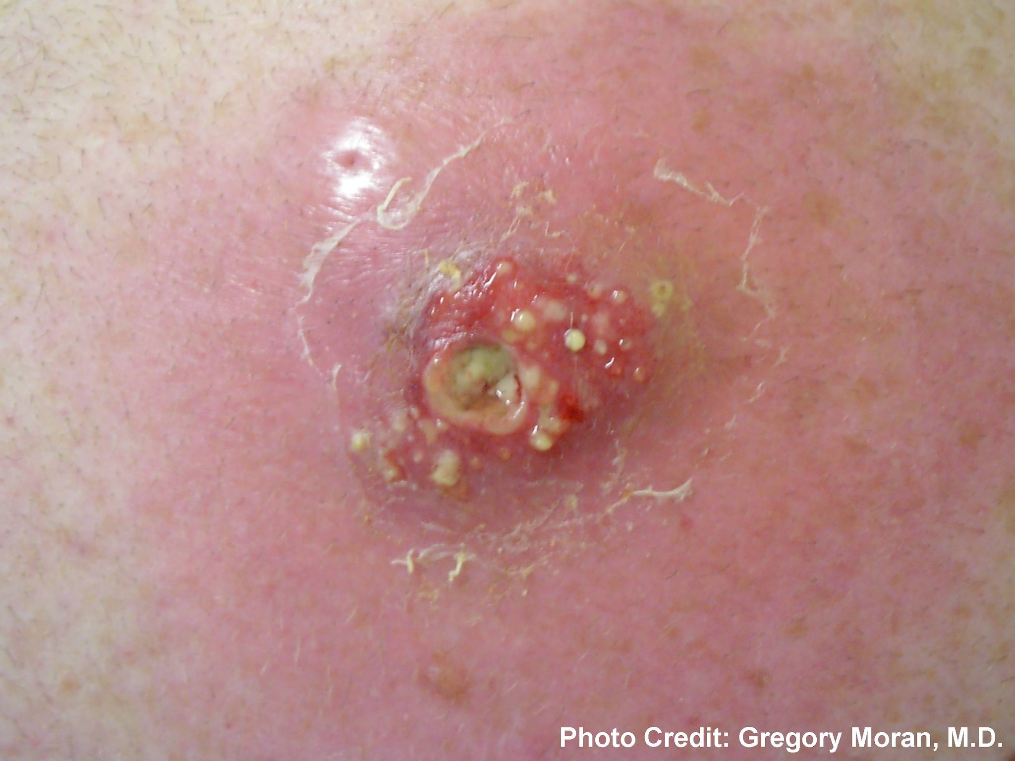 Close up of Cutaneous abscess on the back caused by MRSA