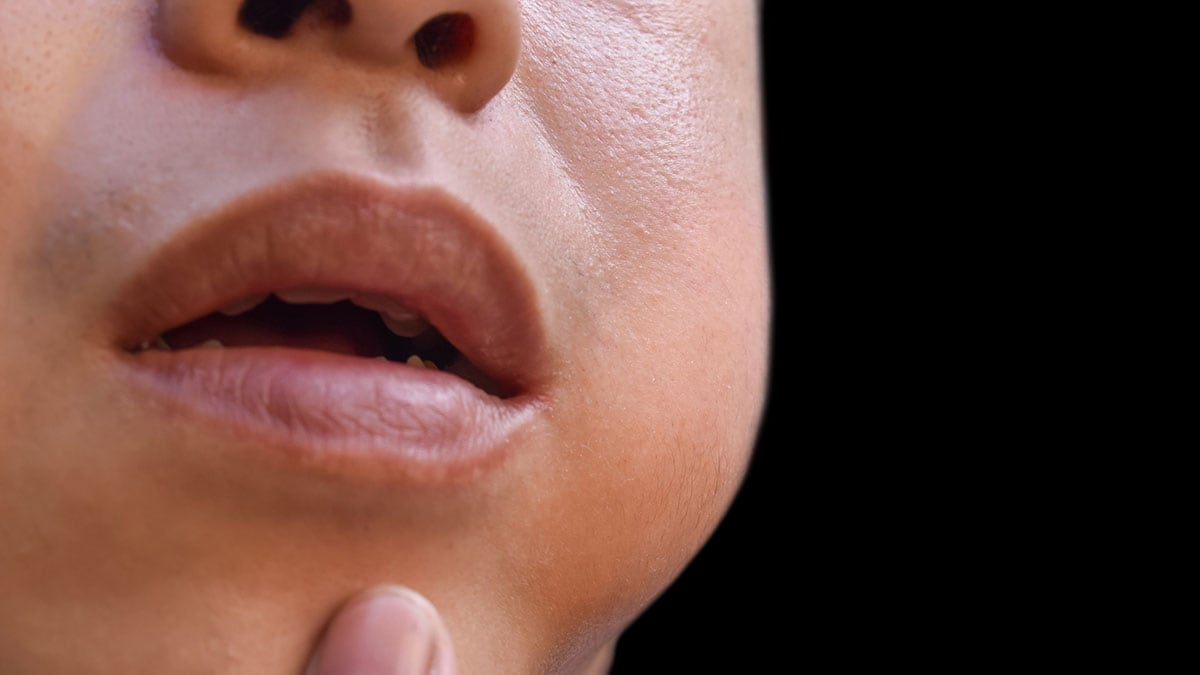 Child with puffy cheeks and swollen jaw caused by mumps.