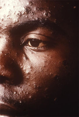 Chickenpox on face Chickenpox on face