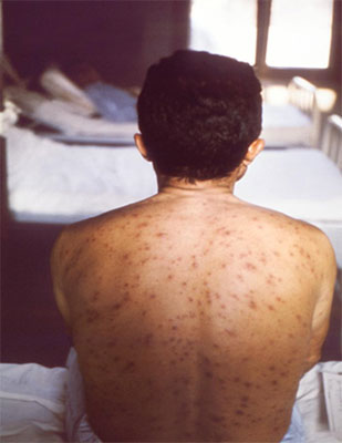 Chickenpox rash on back Chickenpox rash on back