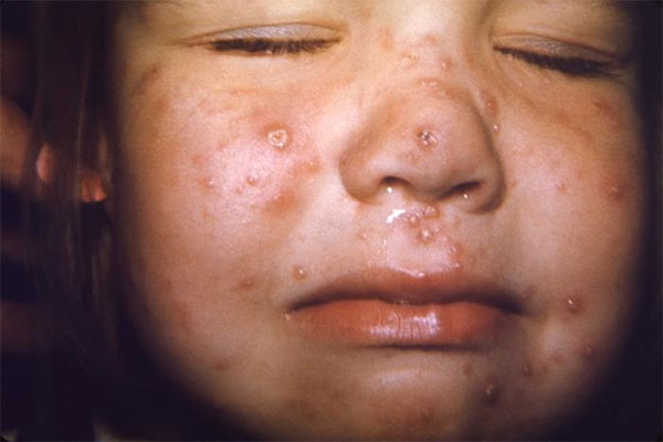 Chickenpox Rash Child Chickenpox rash on young child's face
