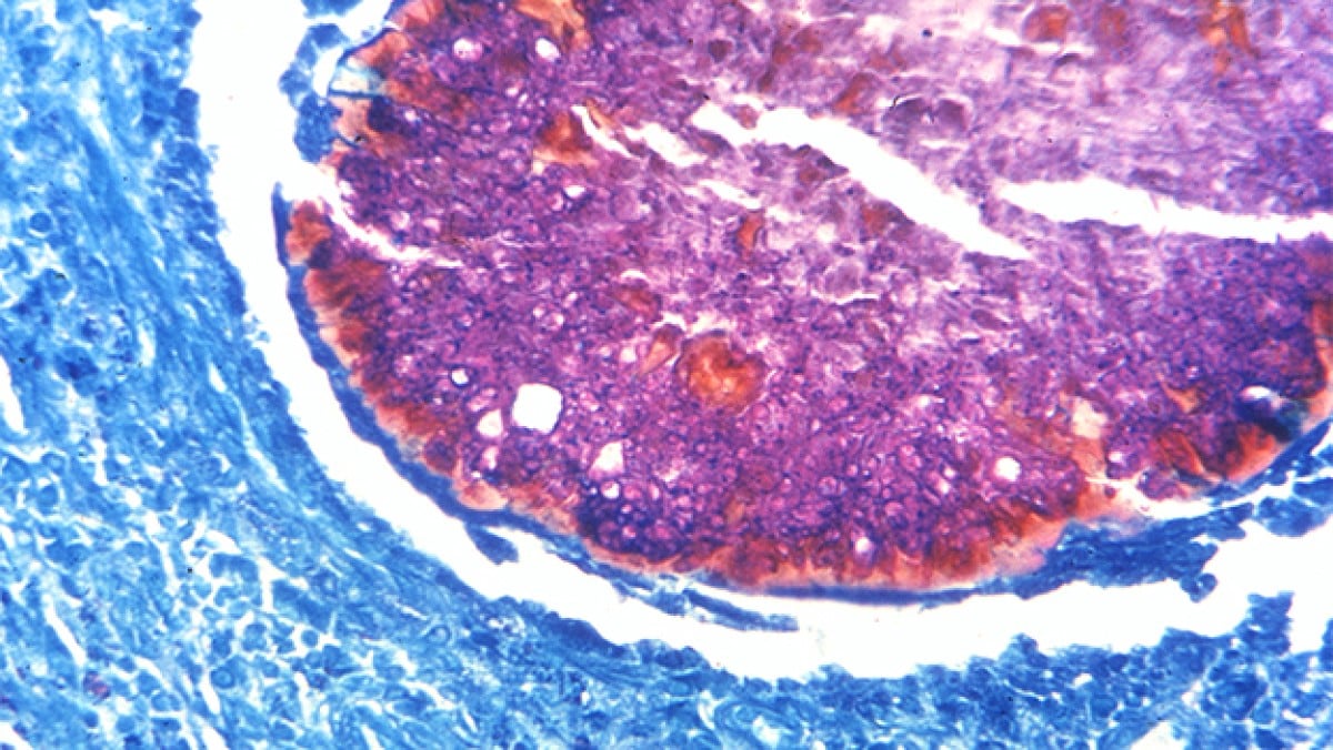 PAS-stained photomicrograph revealing the presence of the fungal organism Madurella mycetomatis in the form of vesicular granules