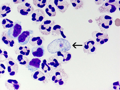 Naegleria fowleri in a patient&rsquo;s cerebrospinal fluid. Arrow points to infectious form of the ameba.