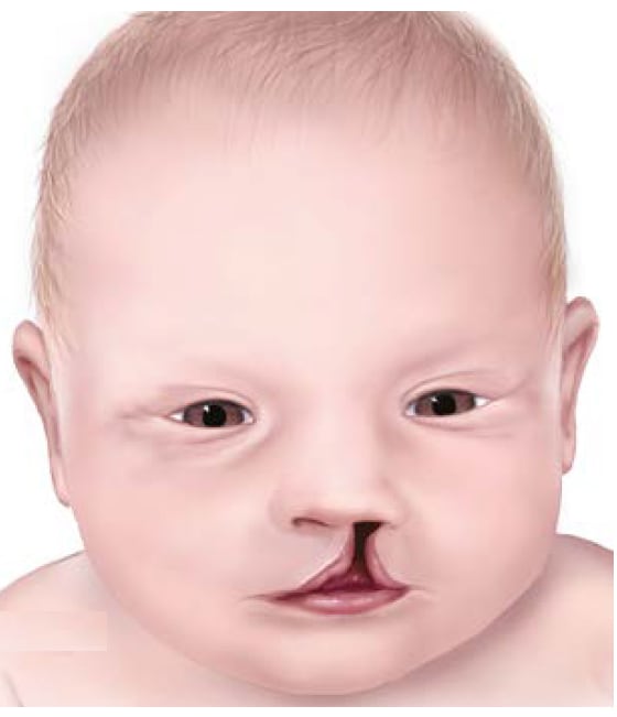 cleft lip and palate before and after