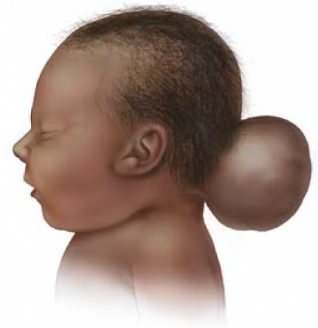 baby with brain outside head