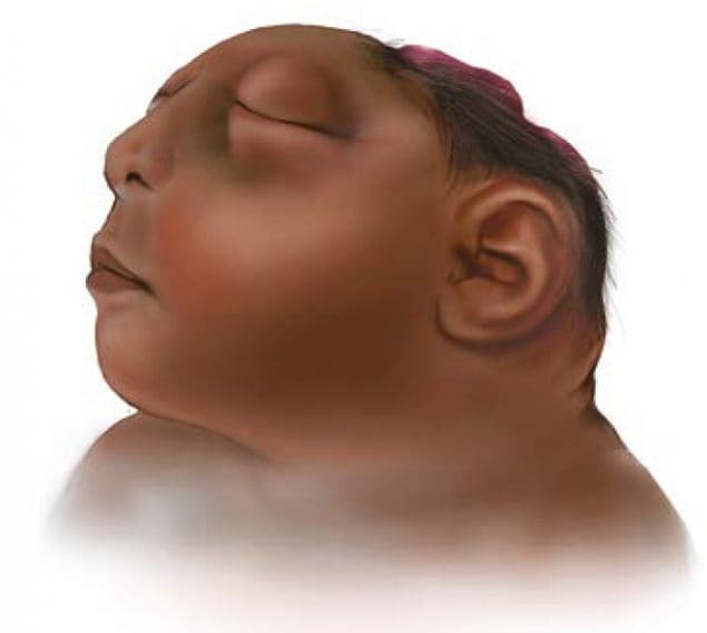 anencephaly survival rate