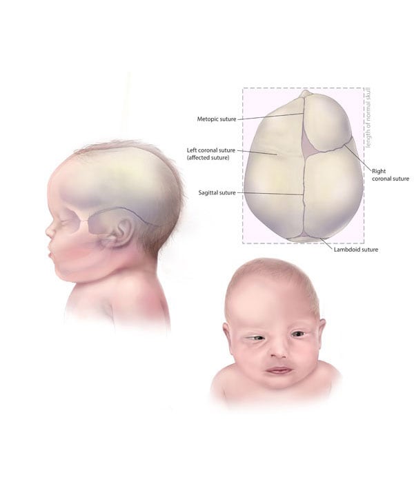 rare birth defect syndromes