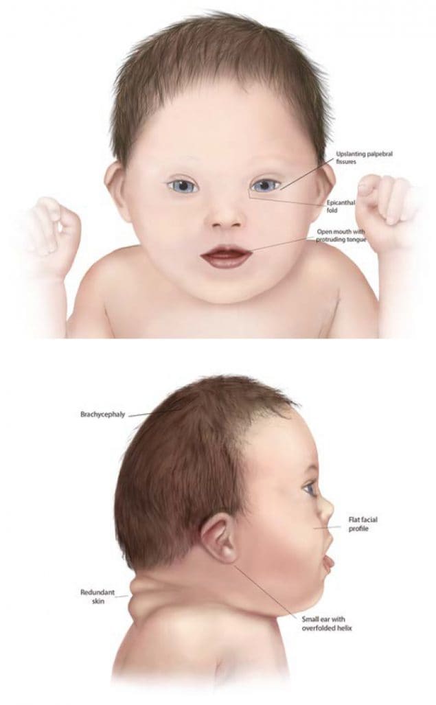 Синдром дауна фото детей новорожденных