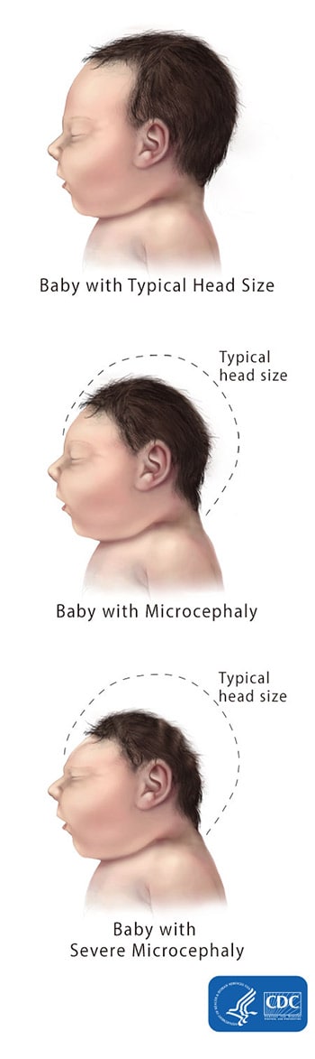 microcephaly newborn