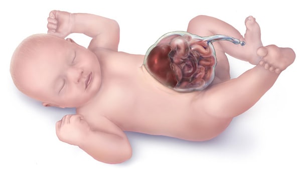 Facts about Omphalocele