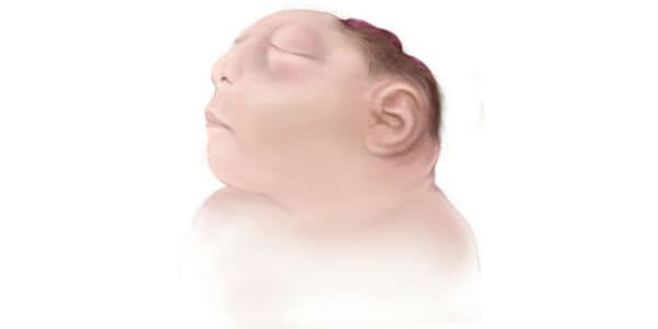 baby with brain outside head
