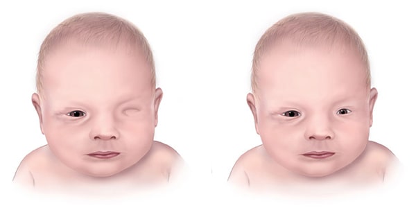 human born with three eyes