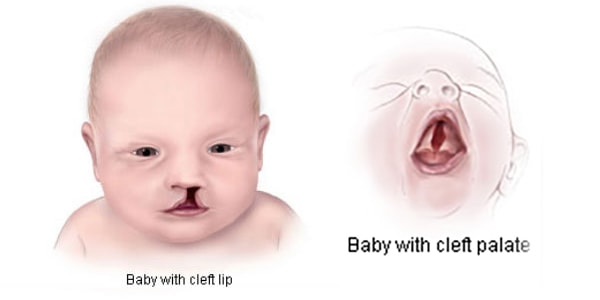 cleft lip statistics