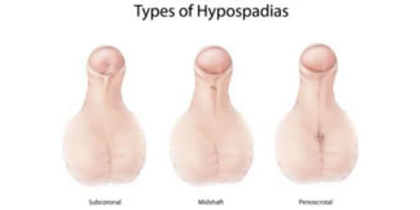 Facts about Hypospadias