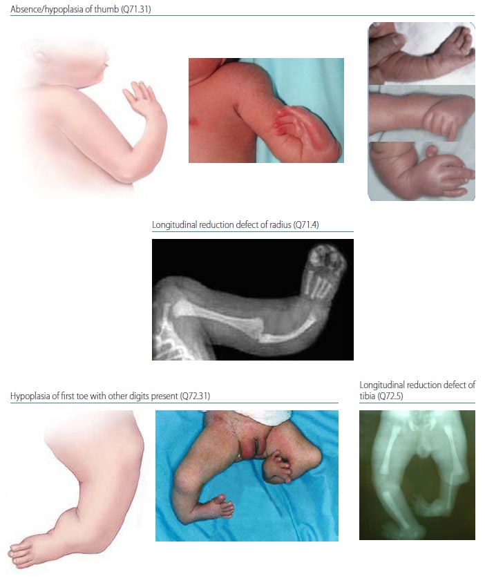 congenital limb deficiency